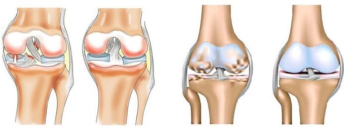 Mene ne cututtukan arthritis da arthrosis